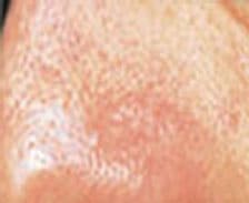 Hand & Facial Veins | Laser Treatment After| Toronto