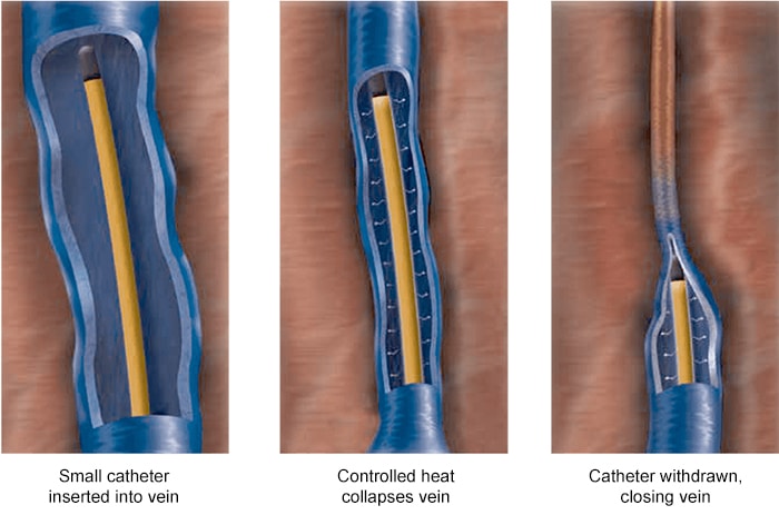 Endovenous Radiofrequency Ablation | Varicose Veins
