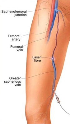 Endovenous Radiofrequency Ablation | Varicose Veins