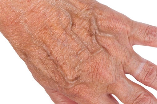 Hand & Facial Veins | Toronto