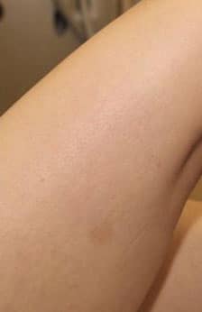 Leg Spider Veins After | The Vein Institute of Toronto