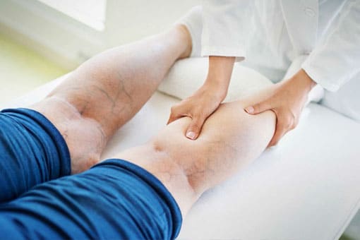 Sclerotherapy for Varicose Veins | Toronto