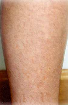 Laser Vein Therapy After