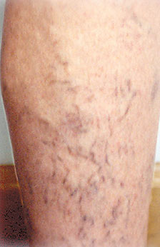 Laser Vein Therapy Before