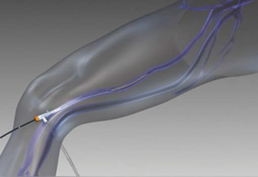 Endovenous Radiofrequency Ablation | Varicose Veins