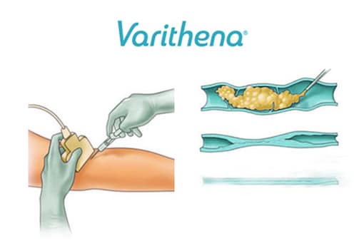 Varithena™ Treatment For Varicose Veins | Toronto