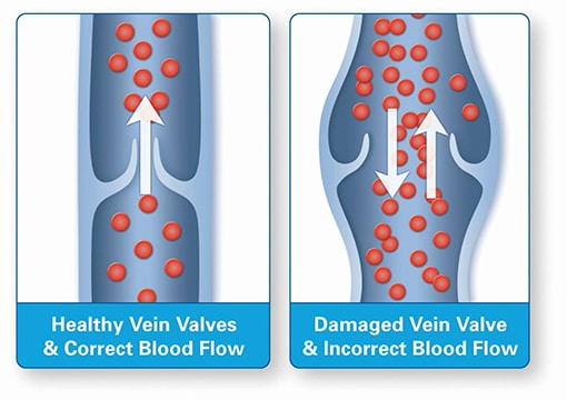 Varicose Veins Signs and Symptoms - Inovia Vein Specialty Center