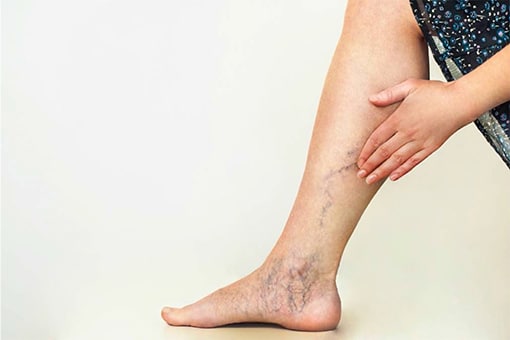 A Doctor Answers All Your Questions About Varicose Veins - Toronto  Dermatology Centre