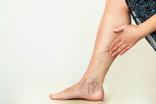 5 Natural Remedies For Varicose Veins