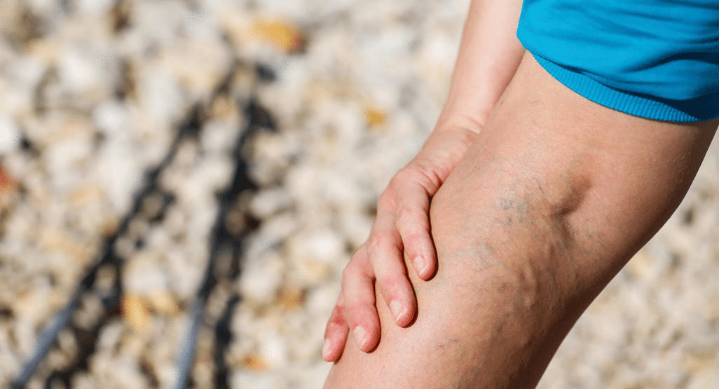 Vascular Vein Institute & Center Toronto, ON - Legs Vein Treatment