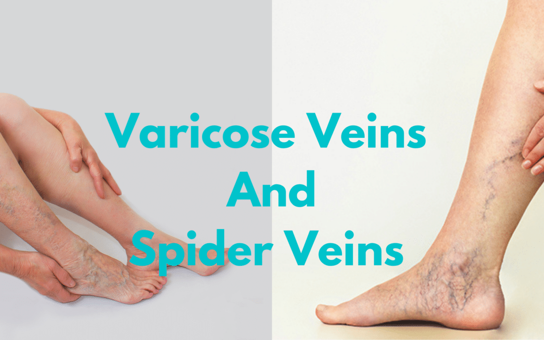 The Difference Between Varicose And Spider Veins