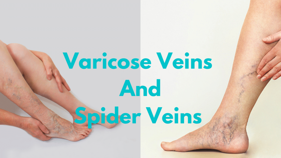 The Difference Between Varicose And Spider Veins - The Vein Institute