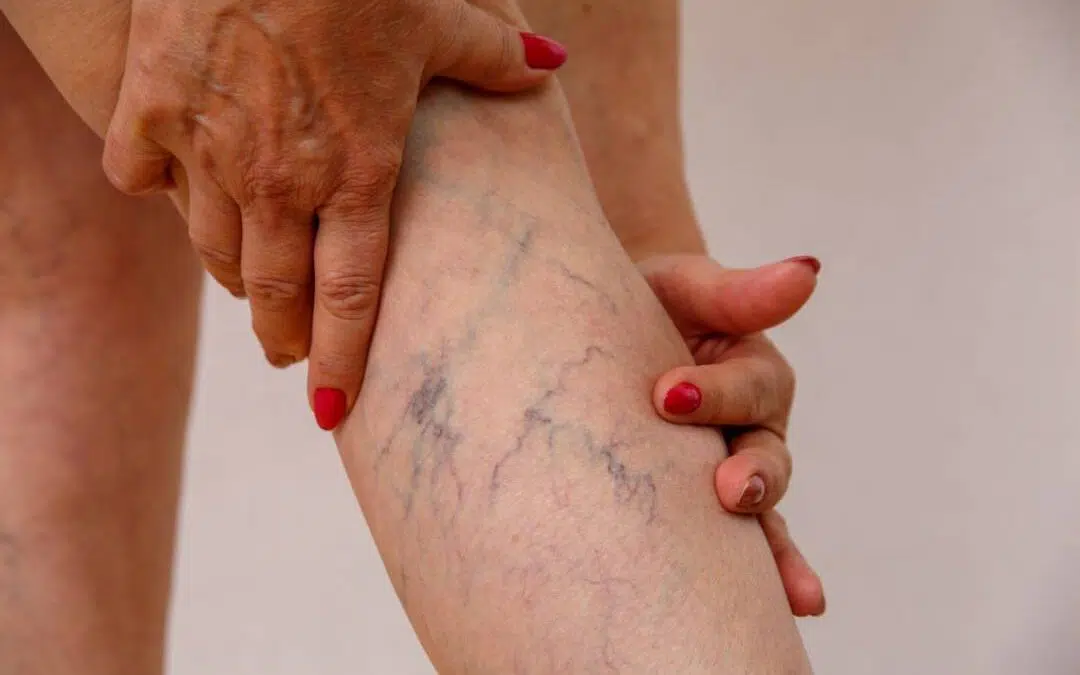 Are Varicose Veins Dangerous?