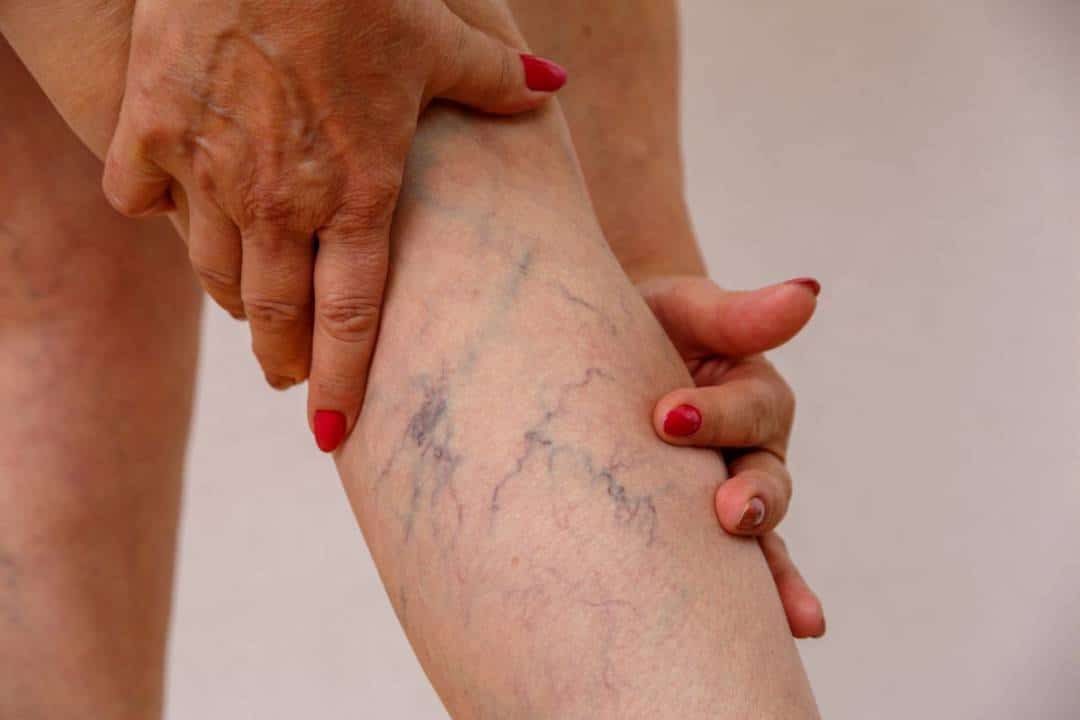 DVT: Hidden Danger of Varicose Veins